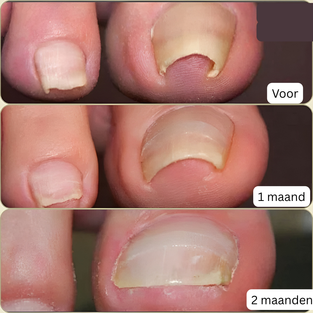 Nagelcorrector – Voor snel herstel en pijnvrije nagels