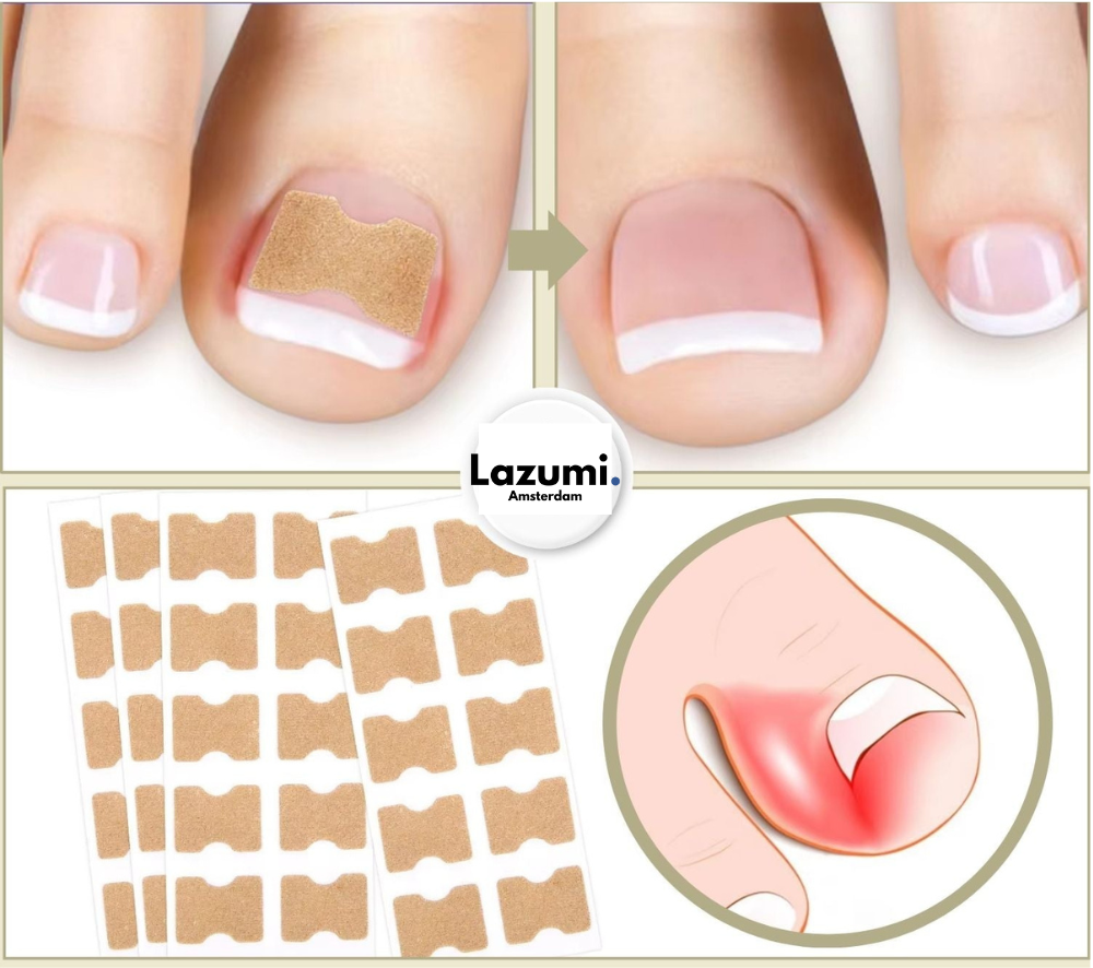 Nagelcorrector – Voor snel herstel en pijnvrije nagels